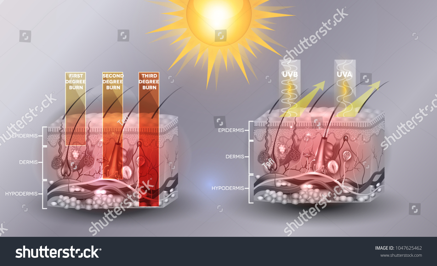 Skin Burn Classification First Second Third Stock Illustration 1047625462