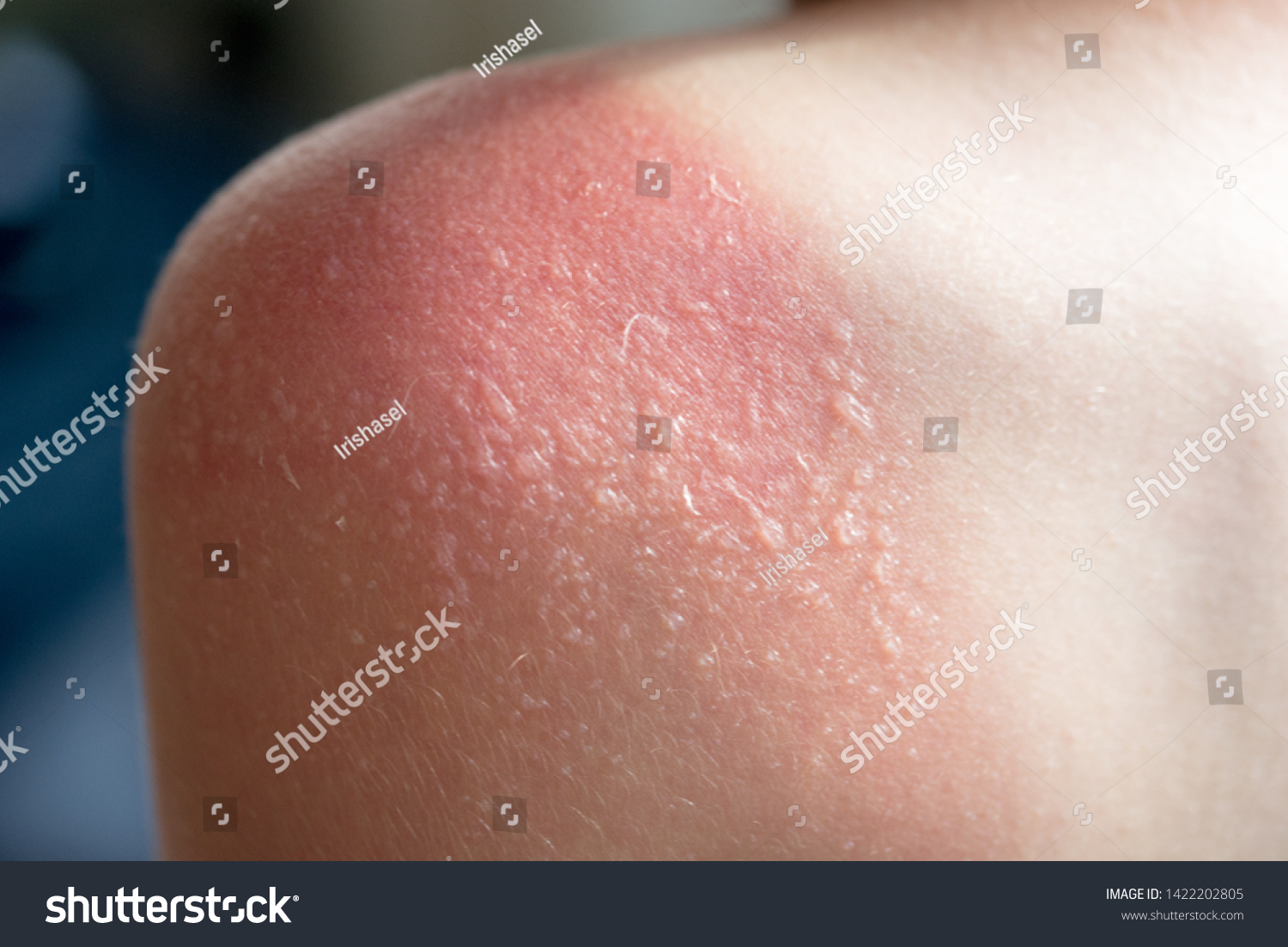 Sunburn blisters Images, Stock Photos & Vectors Shutterstock