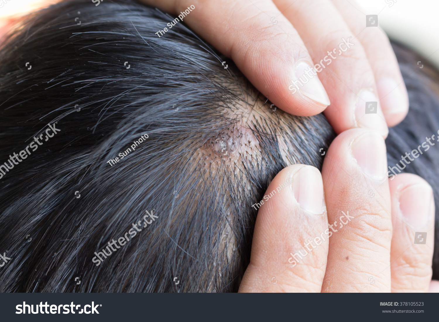 Skin Disease On Head Stock Photo 378105523 Shutterstock