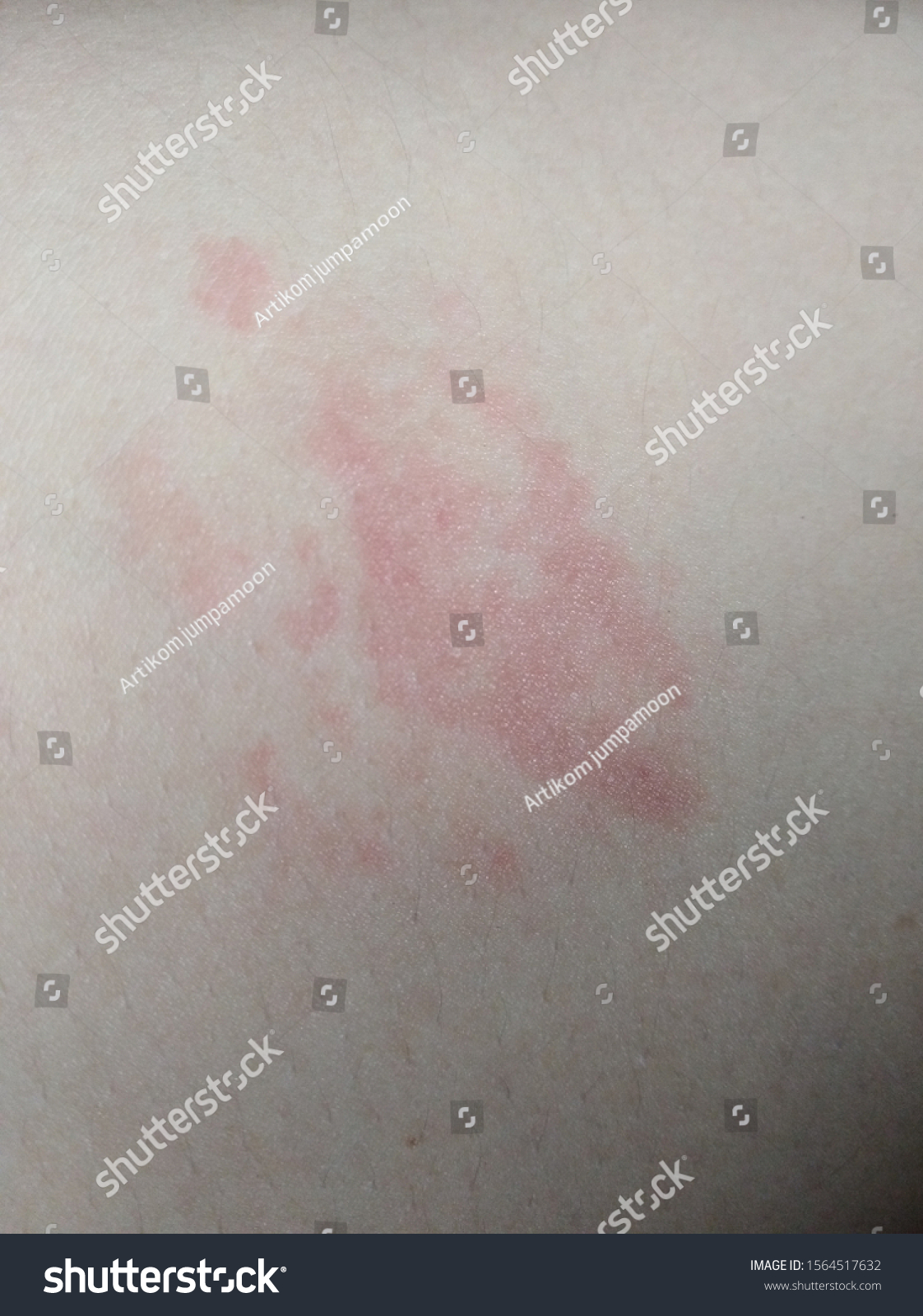 Skin Disease Red Rash Itching Groin : photo de stock (modifiable ...