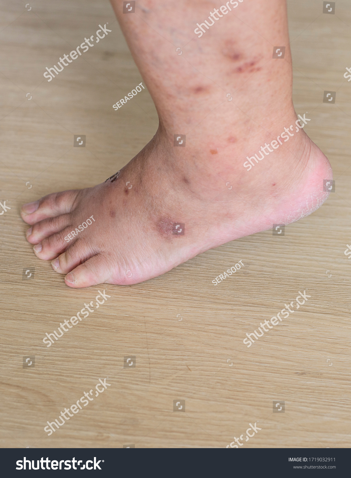 Skin Diseases Skin Wounds On Legs ภาพสต็อก แก้ไขตอนนี้ 1719032911