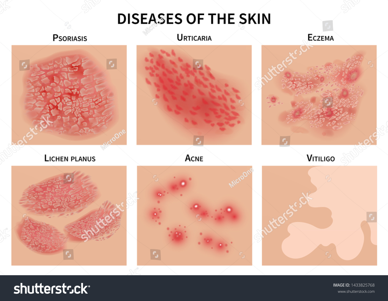 Skin Diseases Derma Infection Eczema Psoriasis Stock Illustration