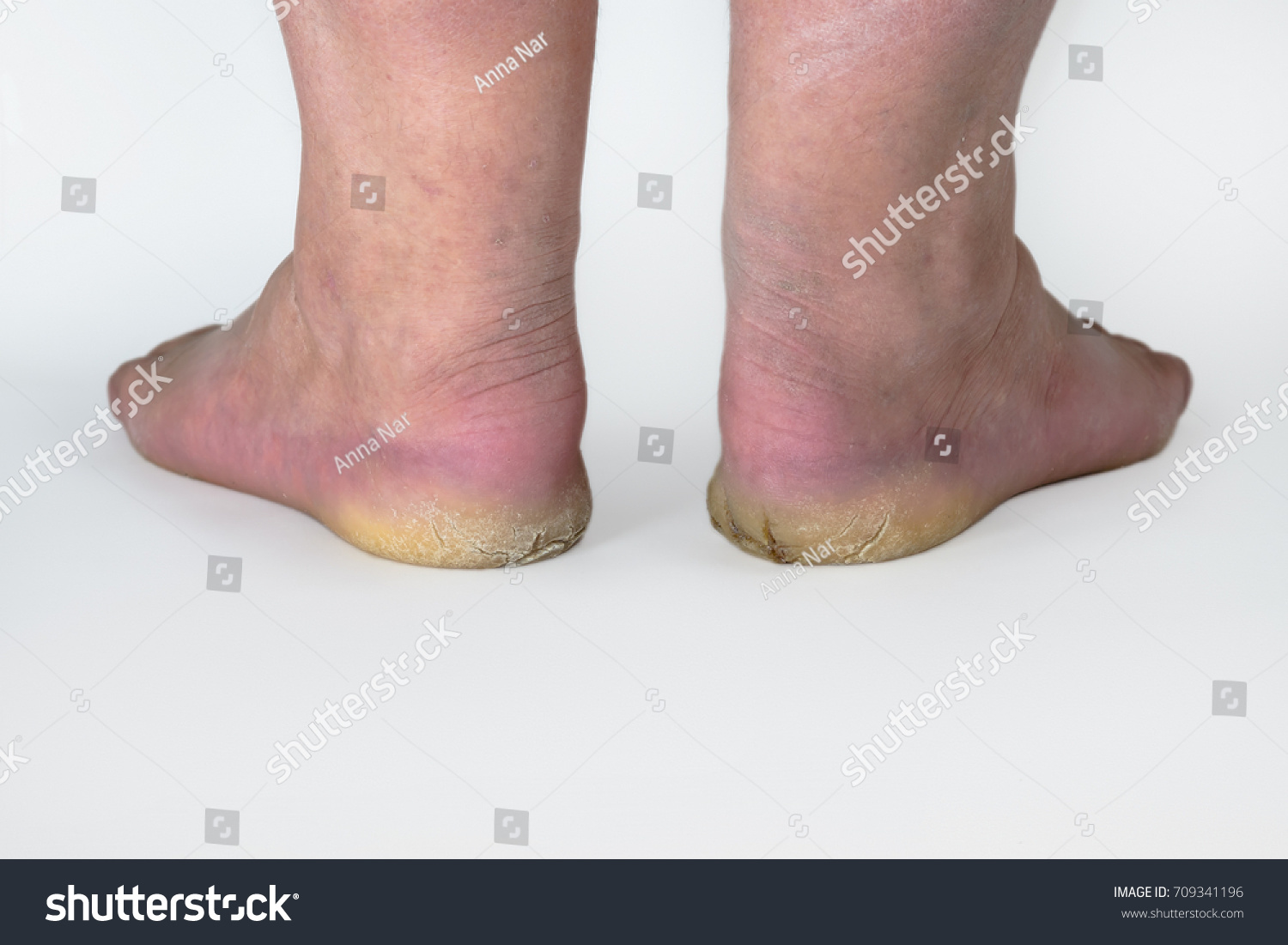 heel skin disease