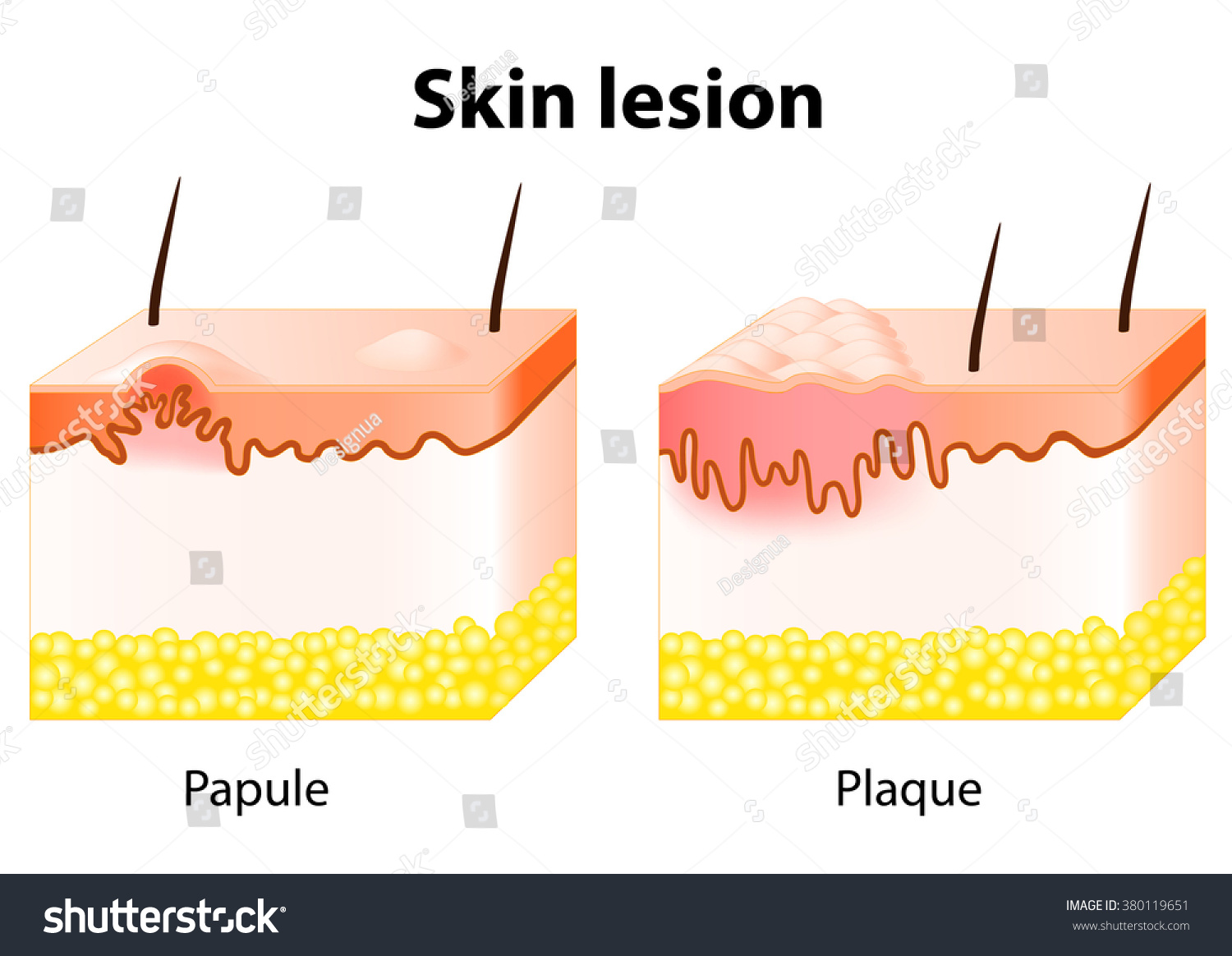 Skin Lesion. Papule Is A Solid Elevation Of Skin And Accumulation Of ...