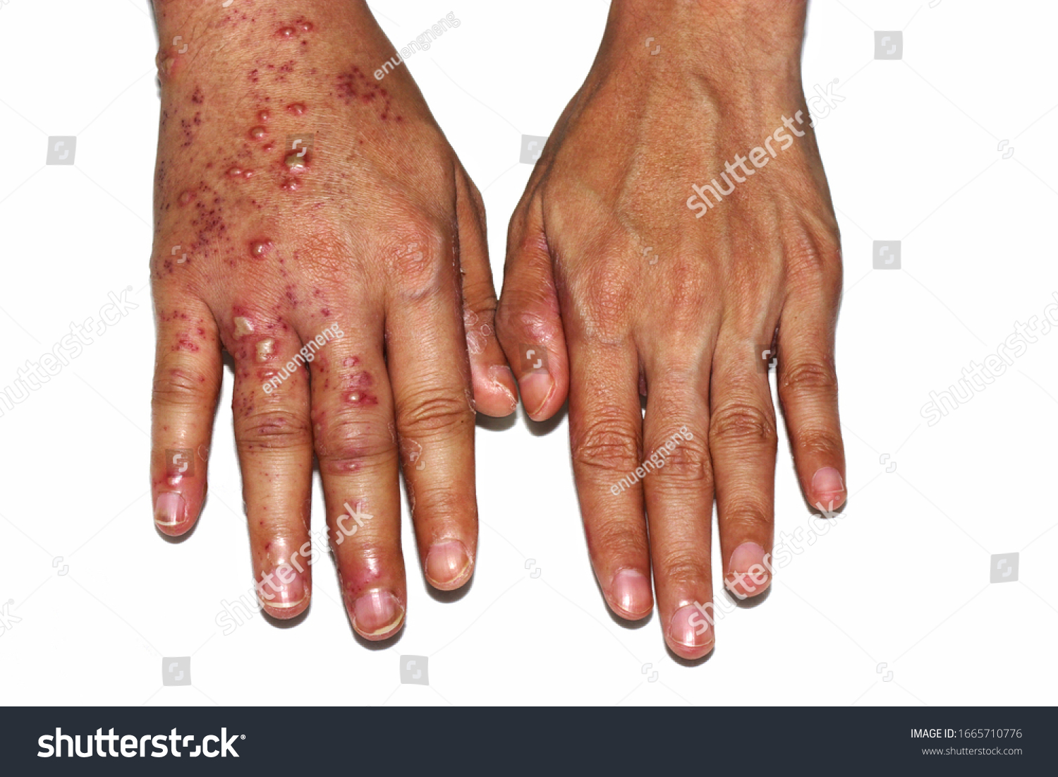 Lésions De Peau Herpes Zoster Sur Photo De Stock Modifiable 1665710776 5978