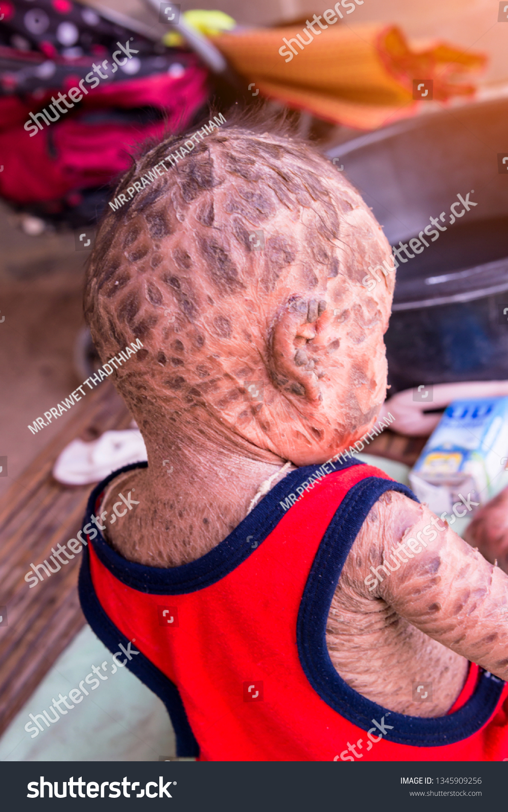 Hakuun Skin Children Harlequin Fetusharlequin Type Ichthyosis Liittyva Arkistovalokuva Muokkaa Nyt 1345909256