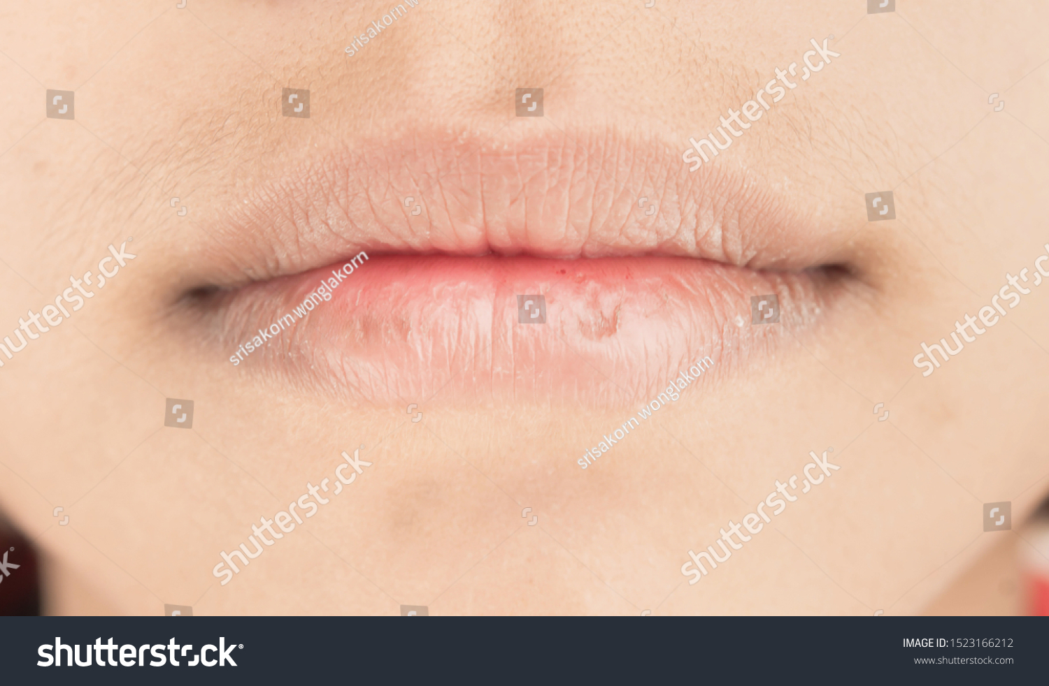 Skin Problem Dry Lips Peeling Face Stock Photo 1523166212 | Shutterstock