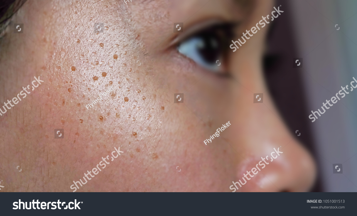 facial seborrheic keratosis Girls that cannot unlock pussy muscles