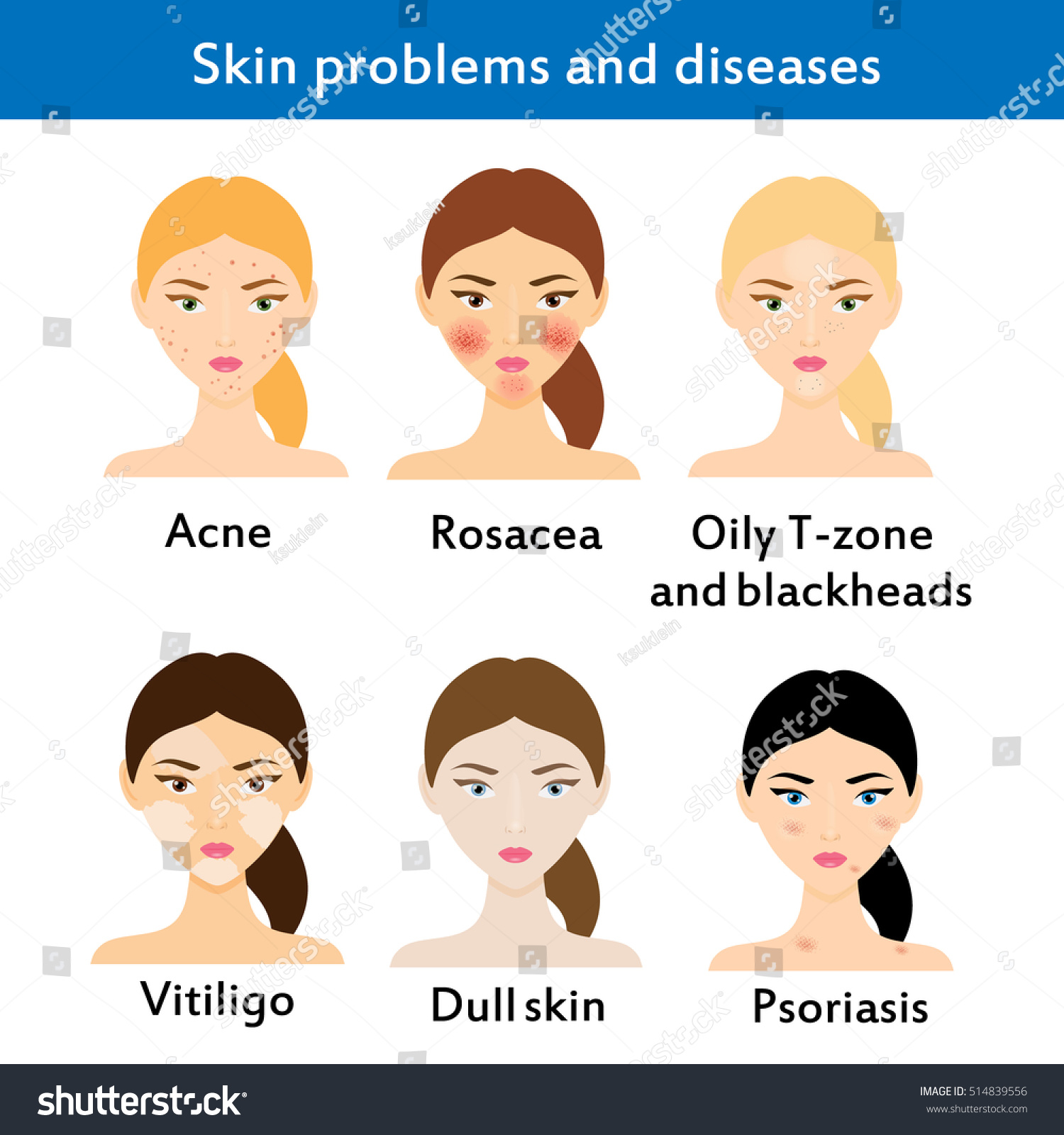 Hautprobleme Und Krankheiten Akne Rosacea Vititligo Stockillustration