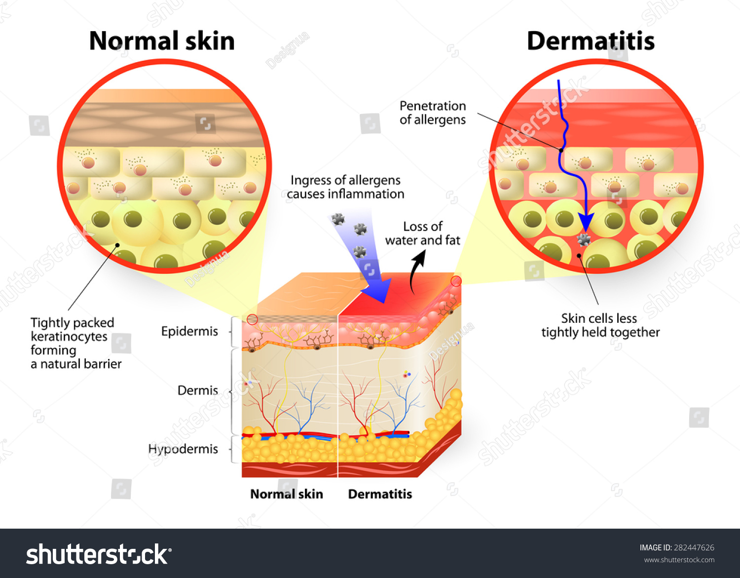 Skin Showing Changes Due Dermatitis Labeled Stock Illustration ...