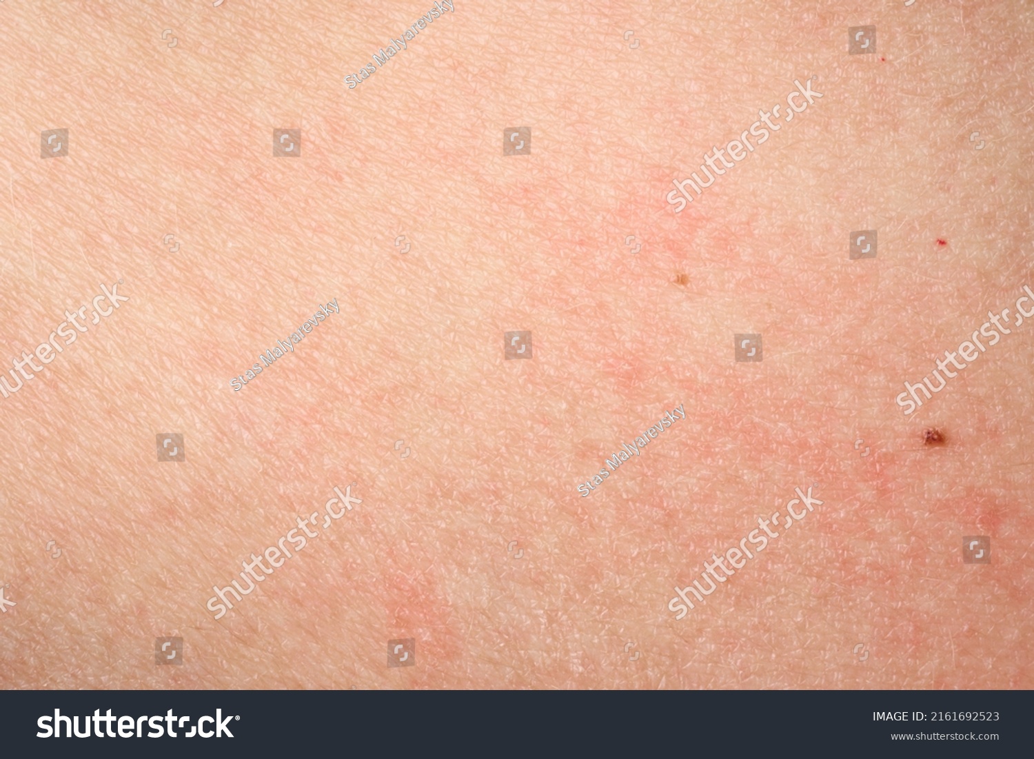 Skin Acne Red Spots Health Problem Stock Photo 2161692523 | Shutterstock