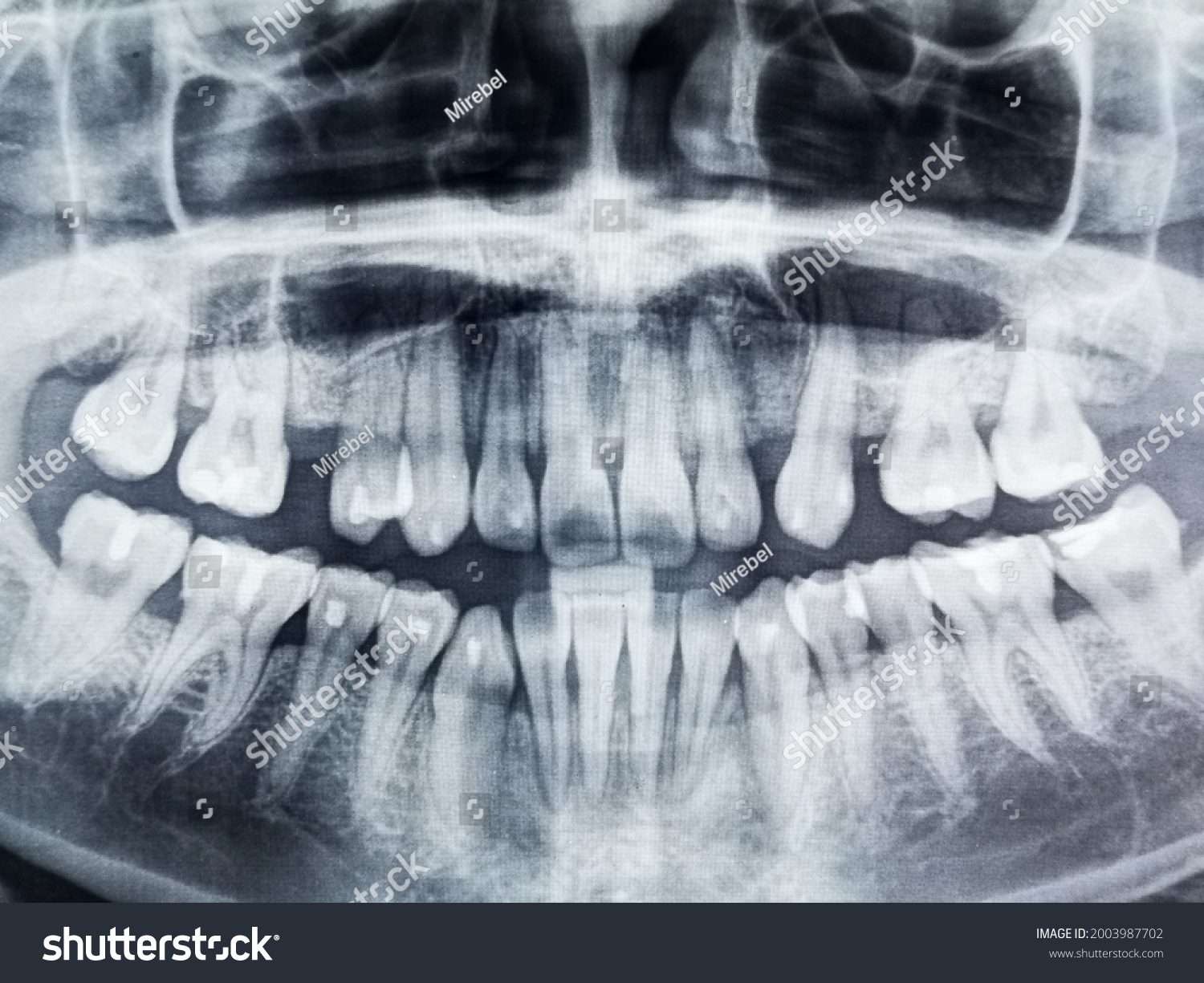 Skull Teeth Xrays Medical Imaging Stock Photo 2003987702 | Shutterstock