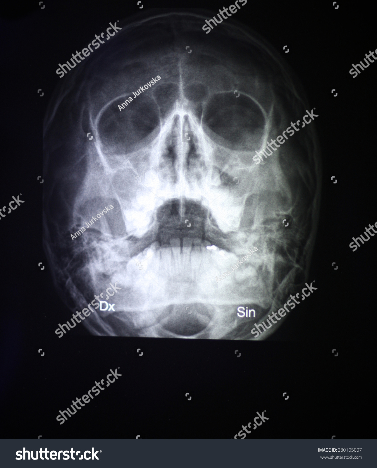 Skull Xray Stock Photo (Edit Now) 280105007