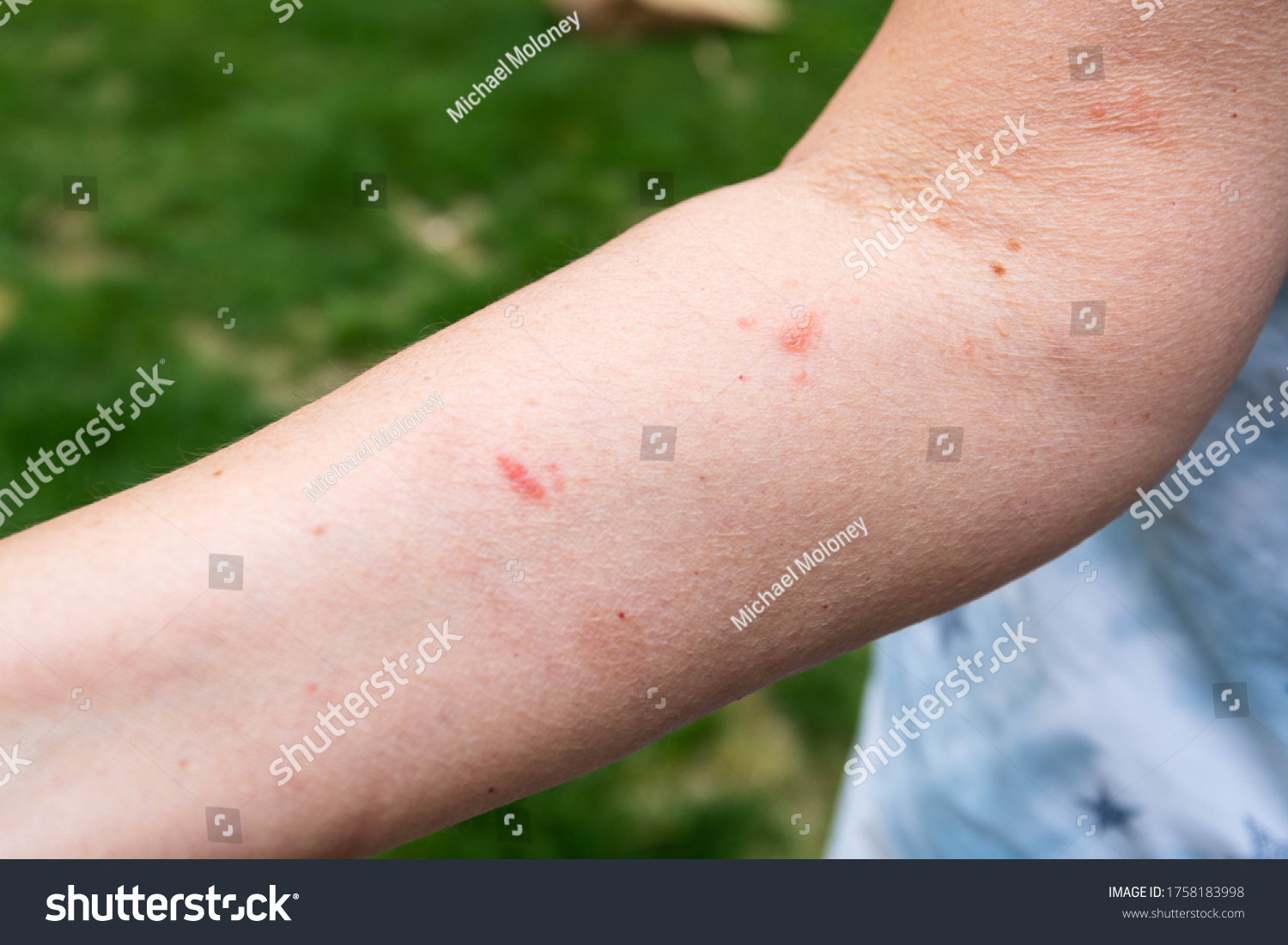Poison Ivy Blisters Accidentally Popped Poison Ivy Blisters Spread at Zoe Bastyan blog