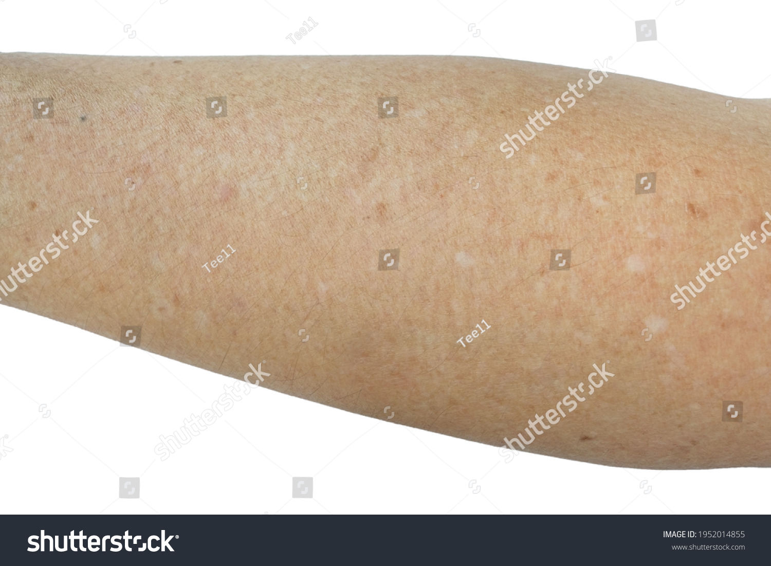 Small White Spots On Arms Idiopathic Stock Photo Edit Now 1952014855 Small White Spots On Arms Idiopathic Stock Photo Edit Now 1952014855