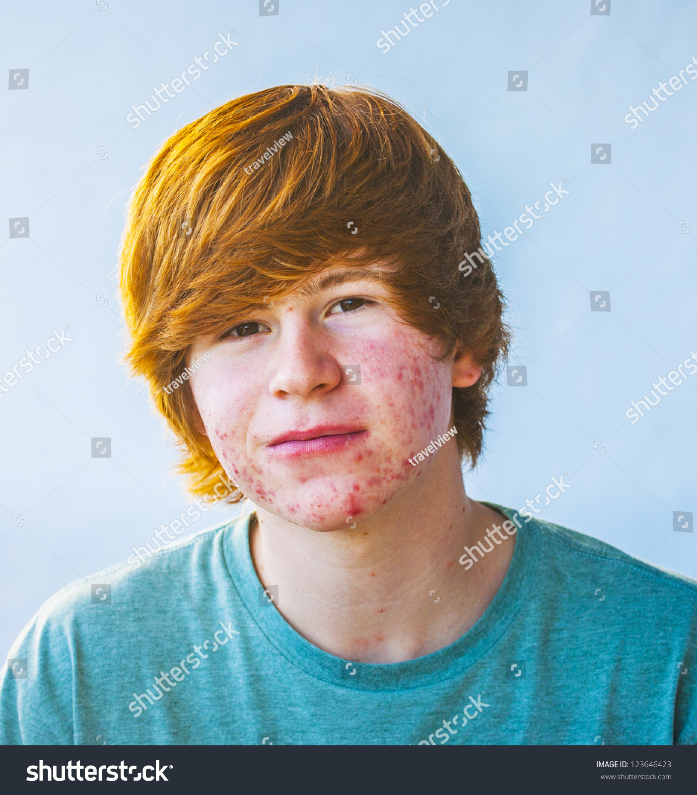 Smart Happy Boy Puberty Acne Stock Photo 123646423 - Shutterstock