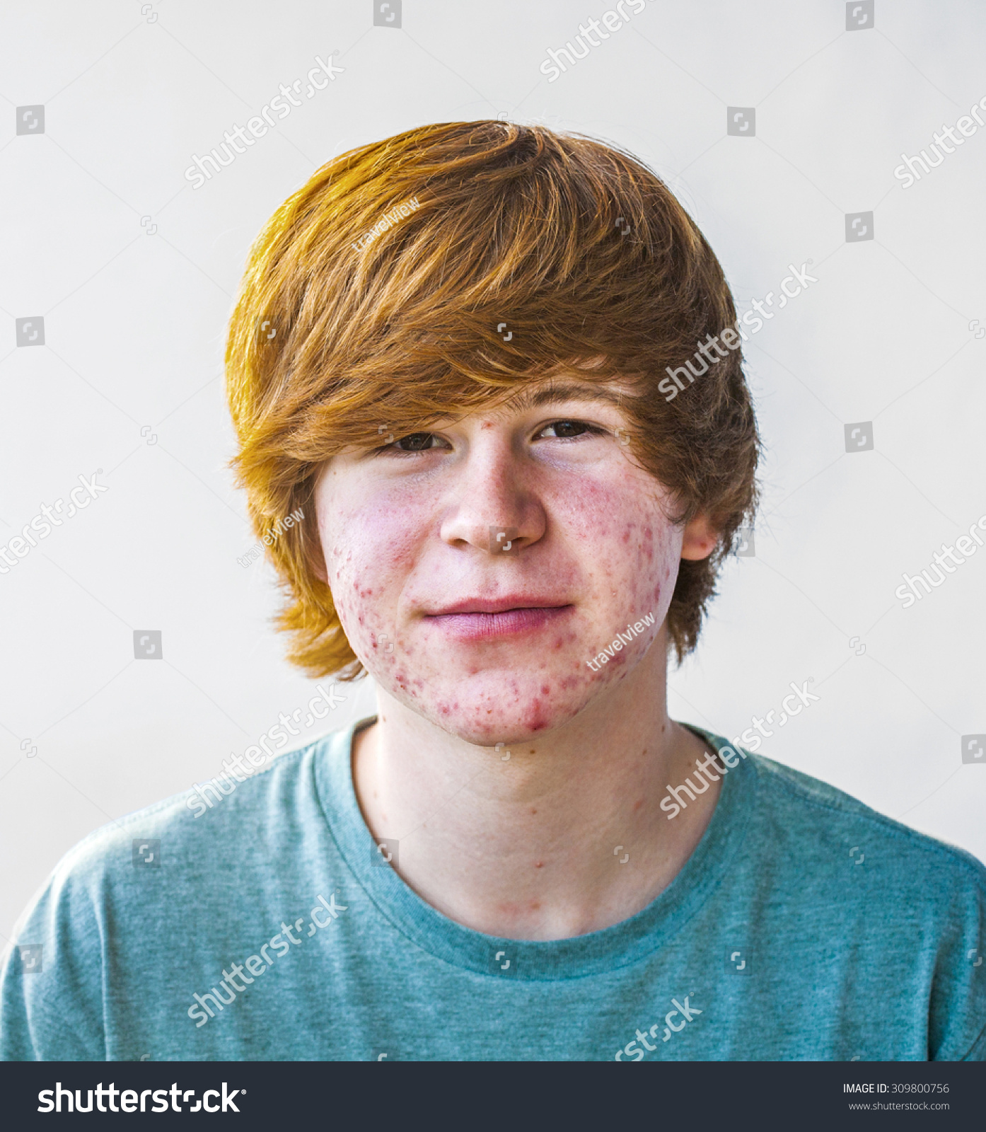 Smart Happy Boy Puberty Acne Stock Photo 309800756 - Shutterstock