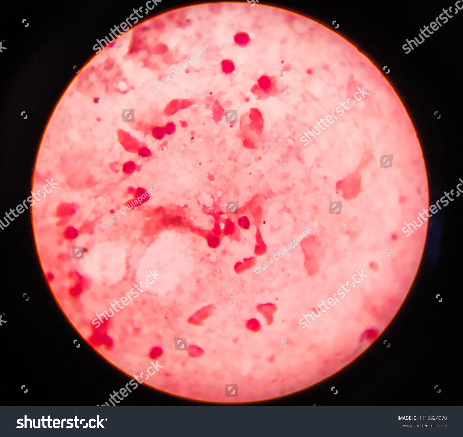 Diplococcus in the smear: what does it show Diplococcus in the smear: what does it show