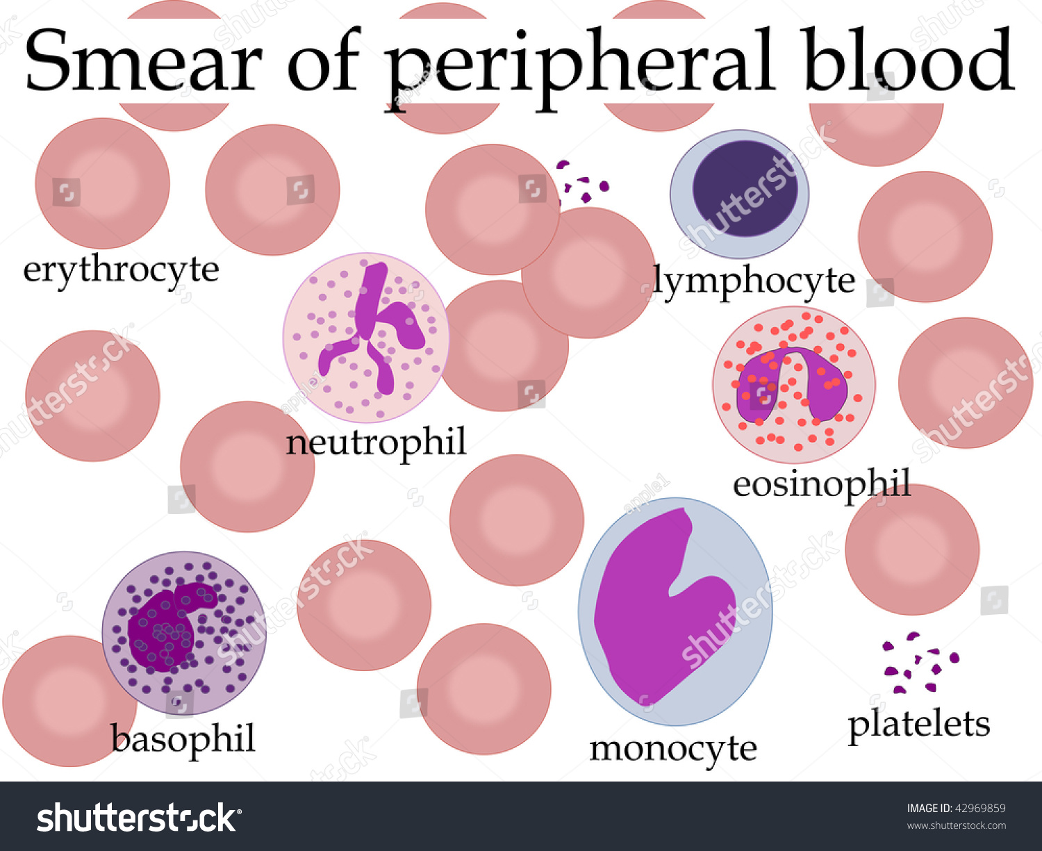 Anemia Peripheral Blood Smear