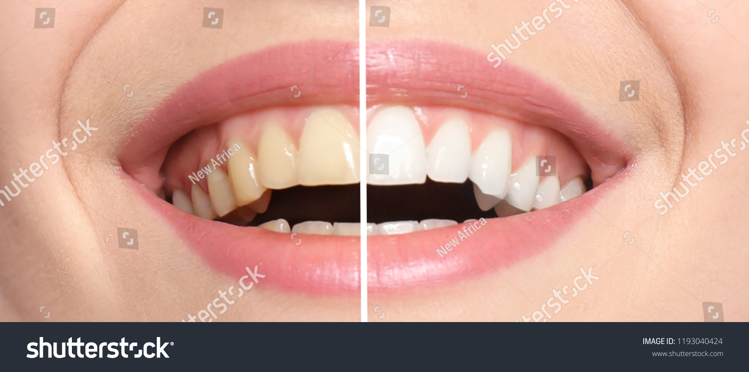 18,204 Dental bleaching Images, Stock Photos & Vectors | Shutterstock