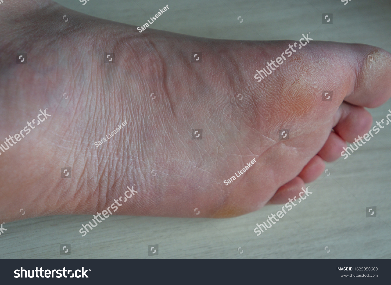 Sole Foot Callus Broken Skin On Stock Photo 1625050660 | Shutterstock