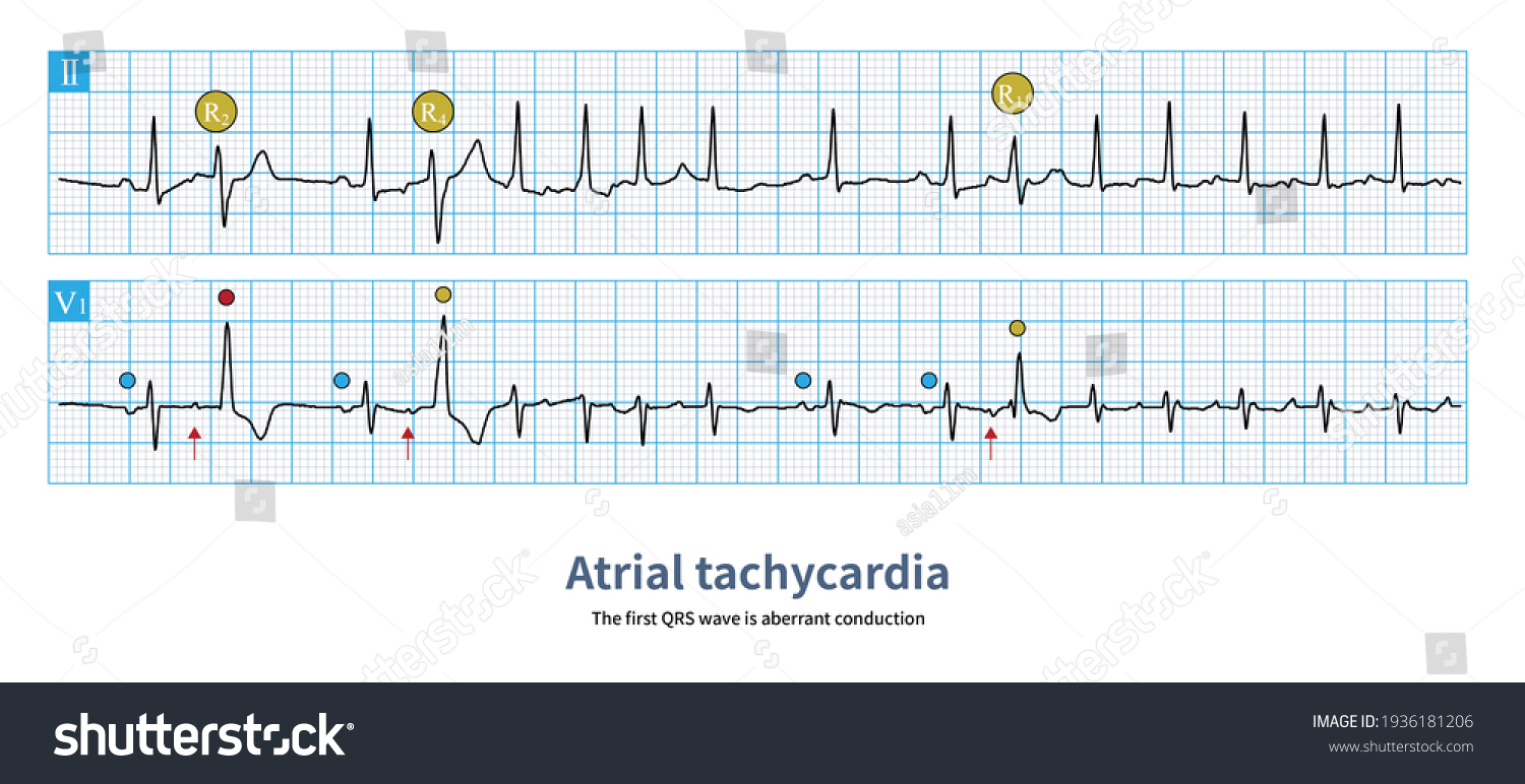 Sometimes First Beat Atrial Tachycardia Shows Stock Illustration ...