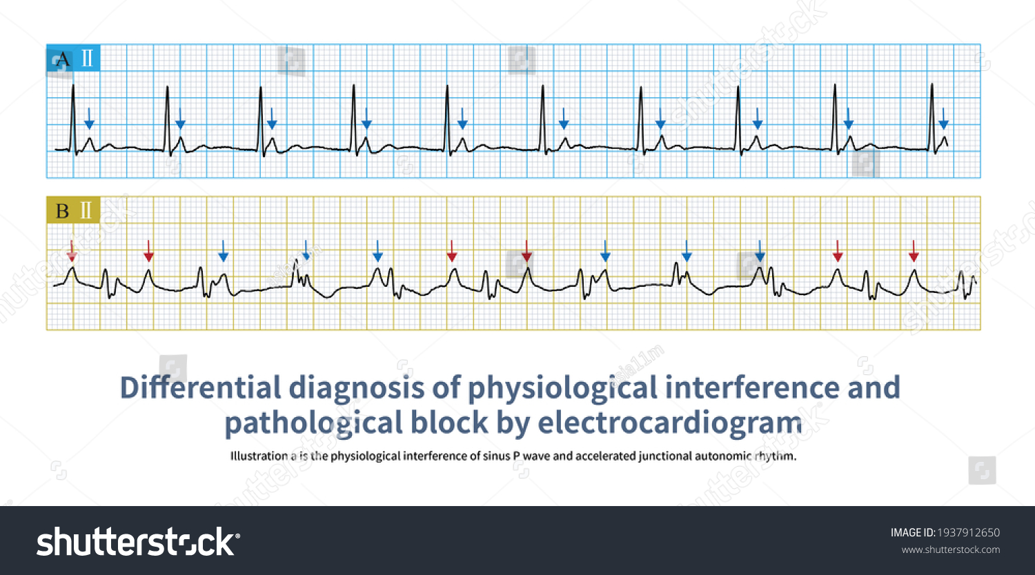 Sometimes Junction Rhythm Sinus Rhythm Form Stock Illustration ...