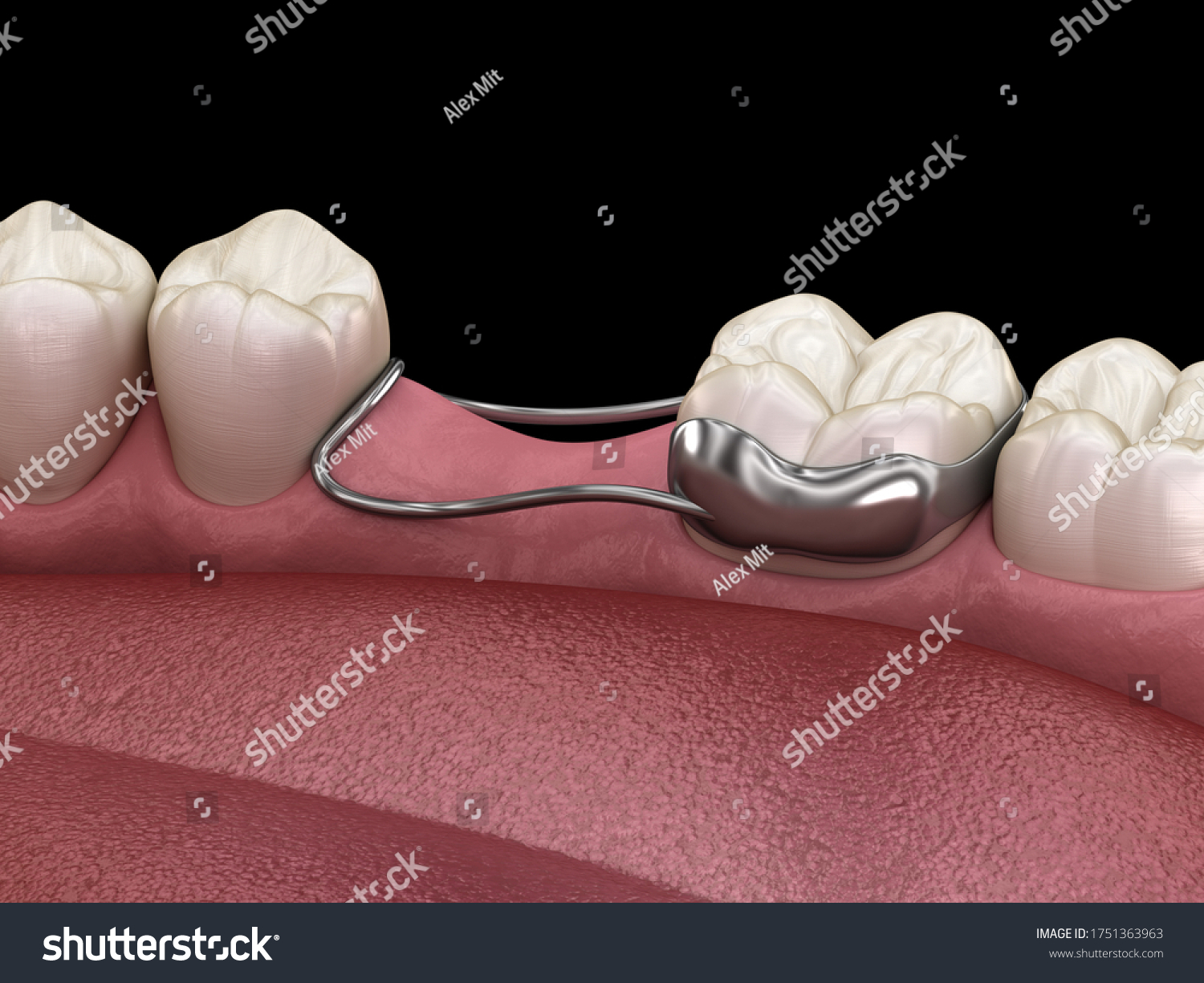 Space Maintainer Unilateral Keeps Teeth Shift Stock Illustration 1751363963 Shutterstock