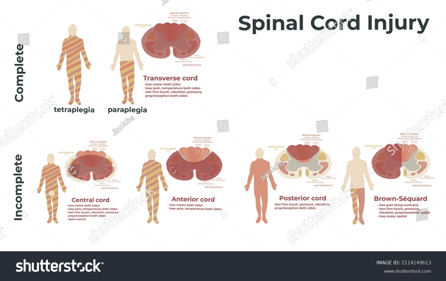 Spinal Cord Injury Illustration Complete Incomplete Stock Illustration ...