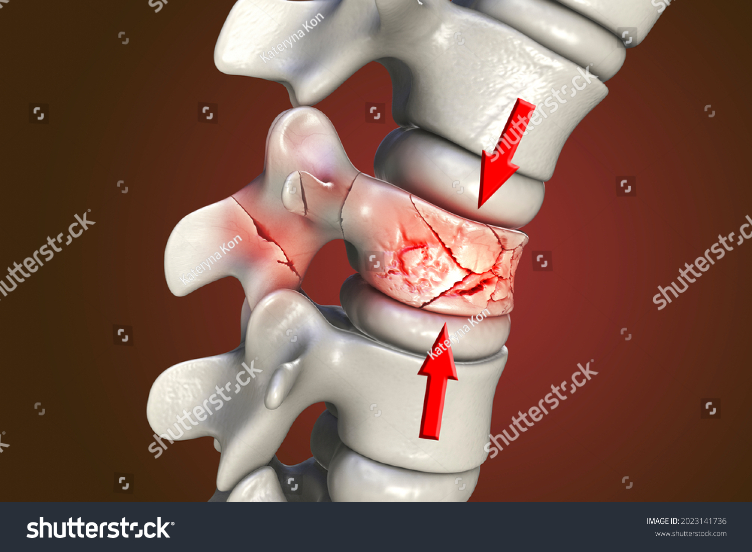 673-compression-fracture-spine-images-stock-photos-vectors