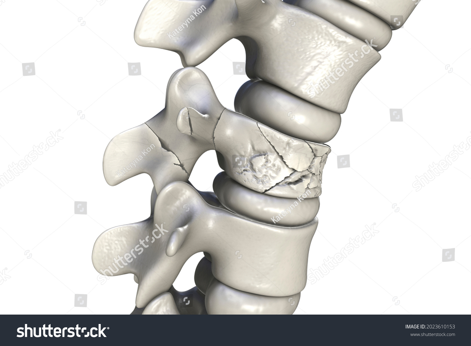 3-554-spinal-fracture-images-stock-photos-vectors-shutterstock