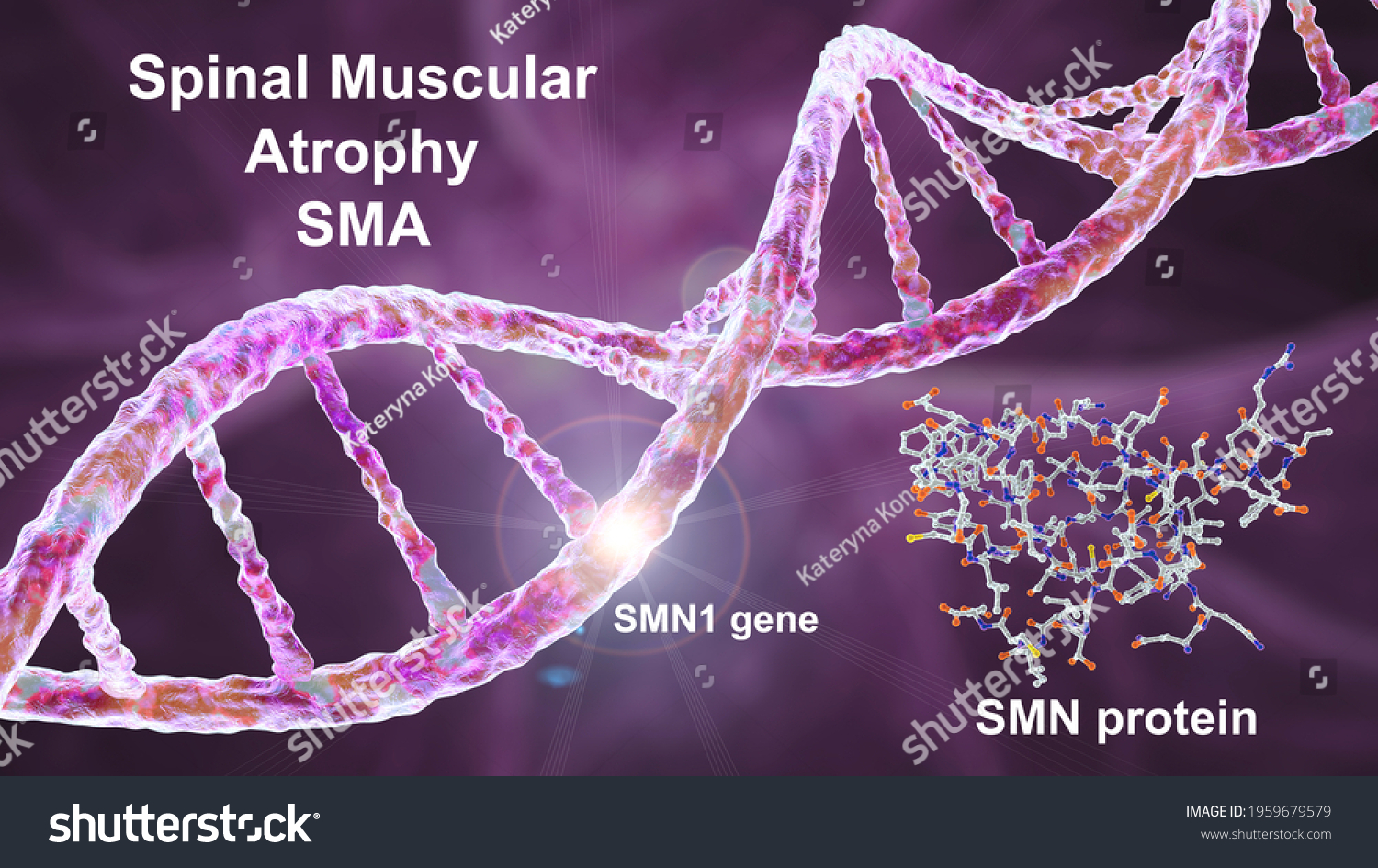 Spinal Muscular Atrophy Sma Genetic Neuromuscular Stock Illustration