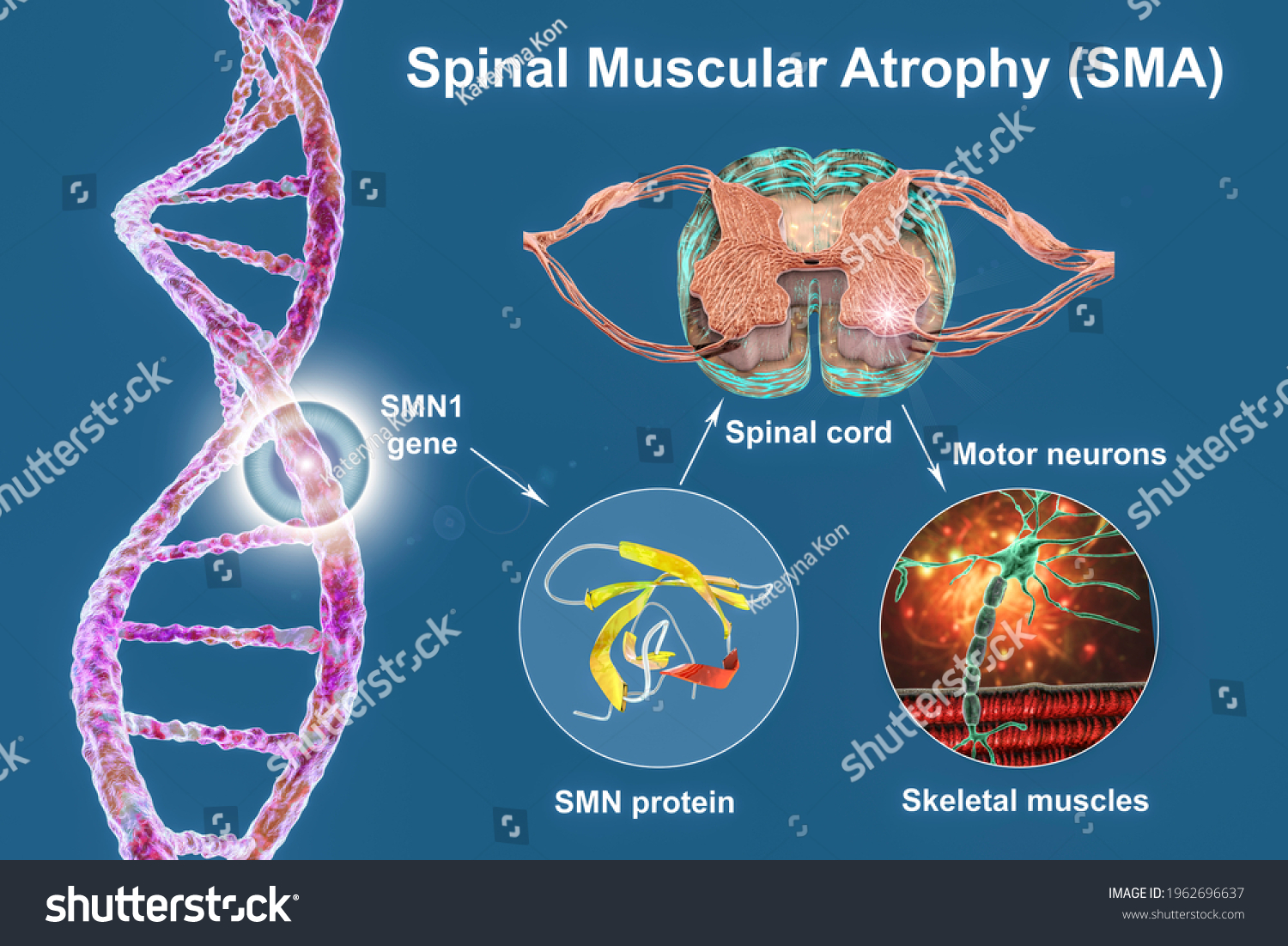 spinal-muscular-atrophy-sma-genetic-neuromuscular