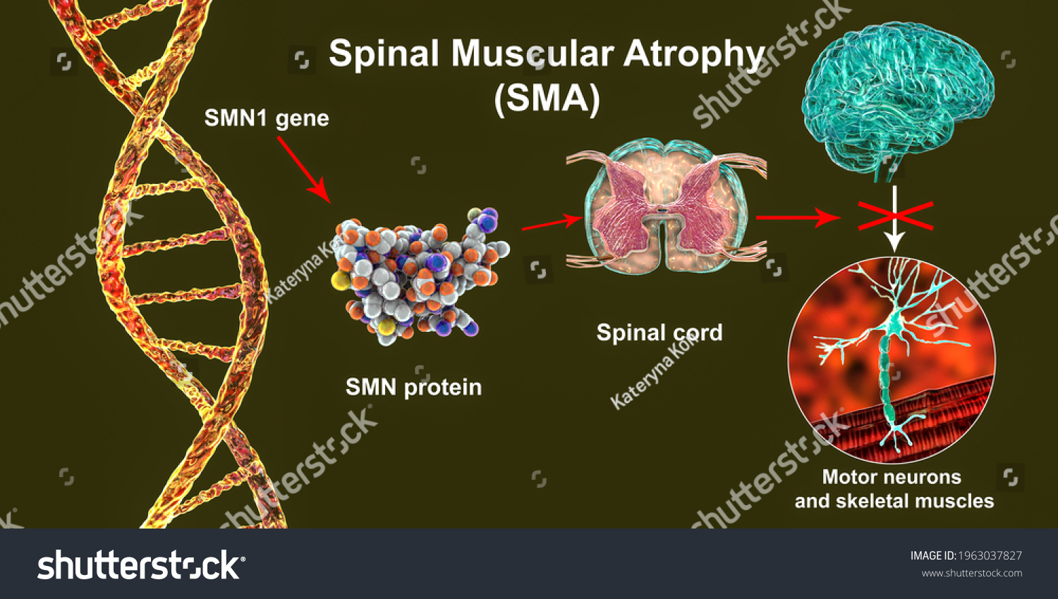 Spinal Muscular Atrophy Sma Genetic Neuromuscular Stock Illustration ...