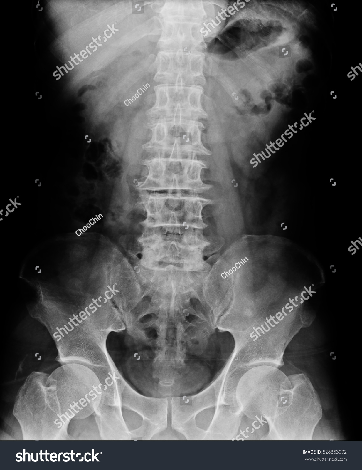 Spine Hip Joint Pelvis Human Body Stock Photo (Edit Now) 528353992 ...