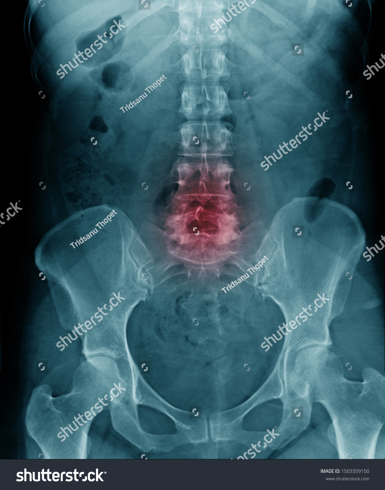 Spondylosis Xray Image Xray Image Compression Stock Photo 1503359150 ...