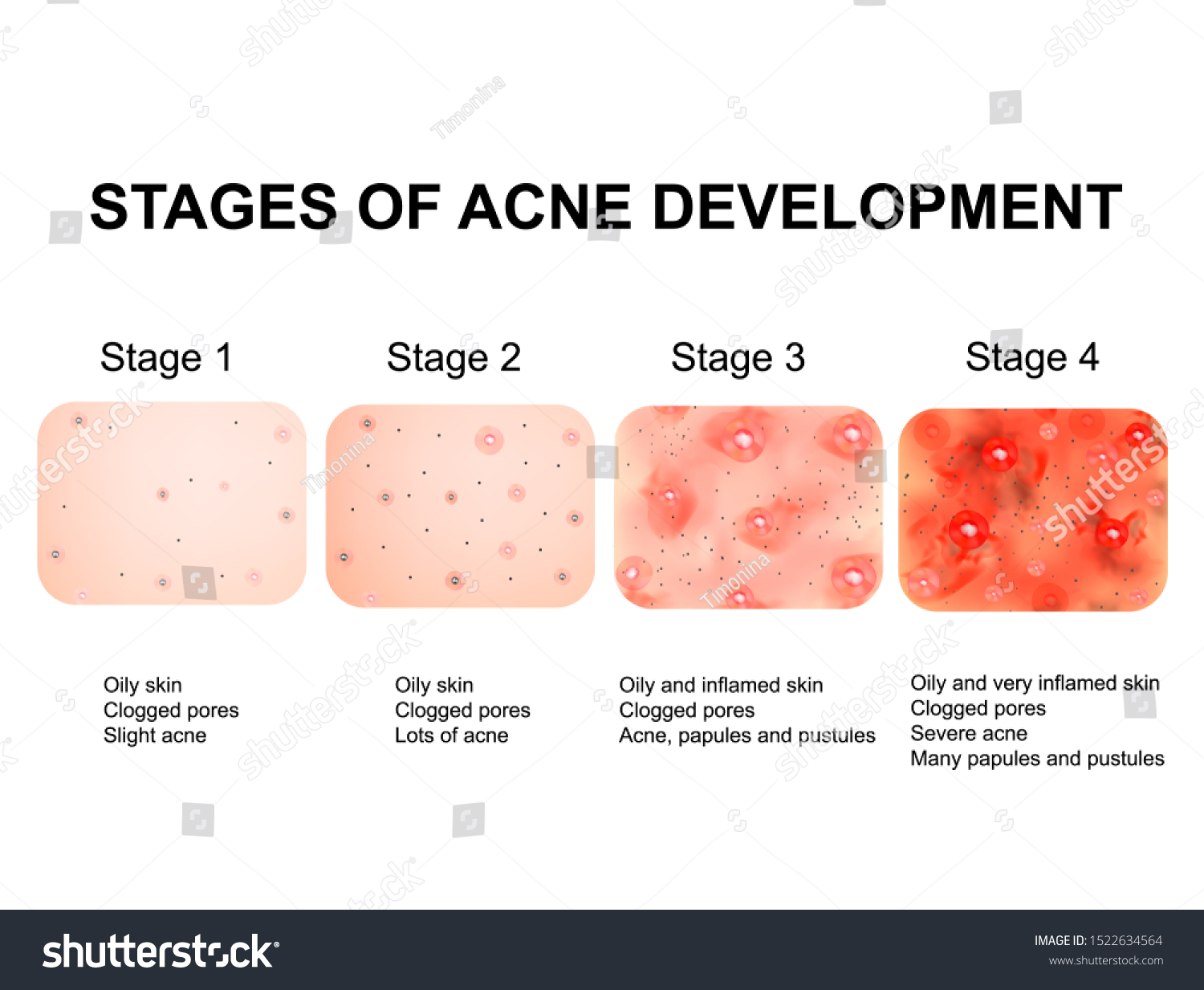 stages-development-acne-inflamed-skin-scars-stock-illustration