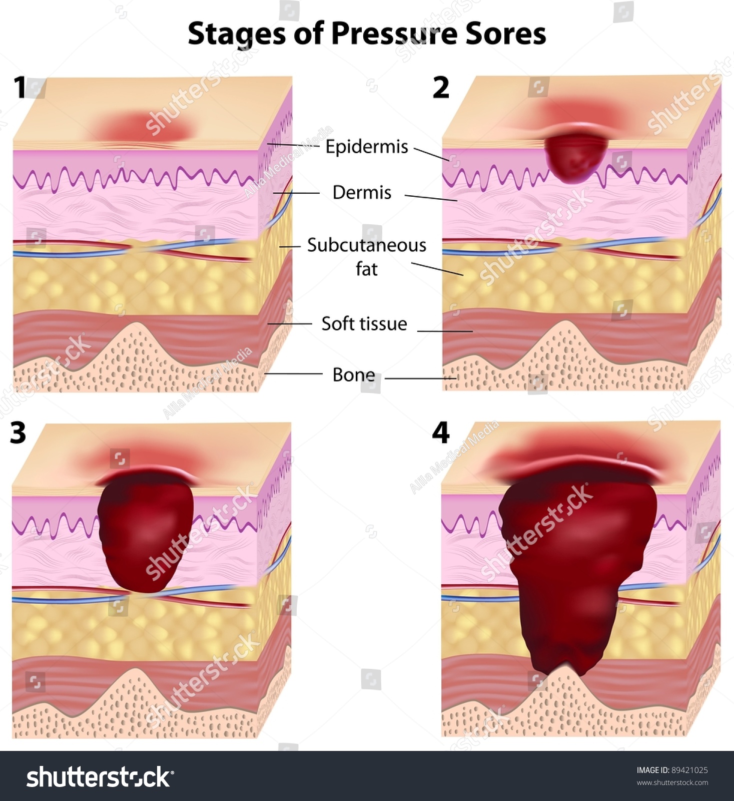 Stages Of Pressure Sores Stock Photo 89421025 : Shutterstock