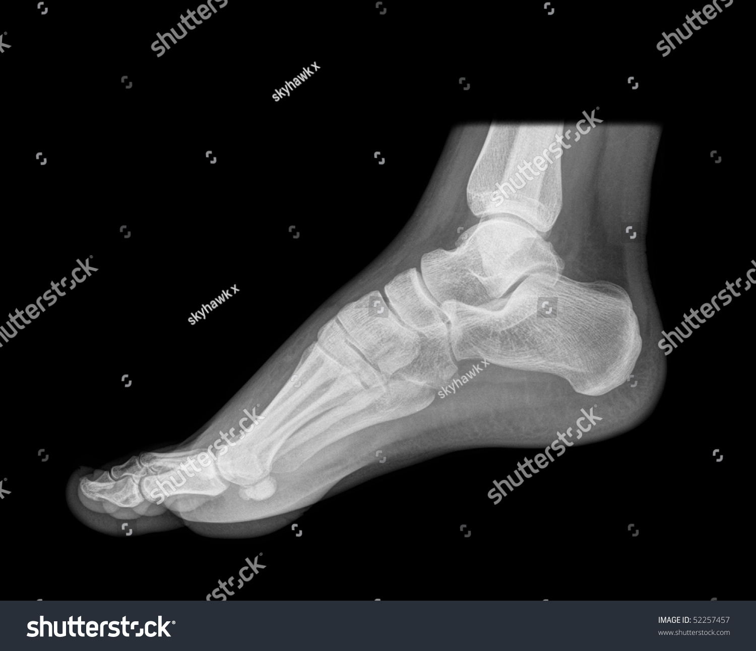 Standing Foot Xray Isolated On Black Stock Photo 52257457 - Shutterstock