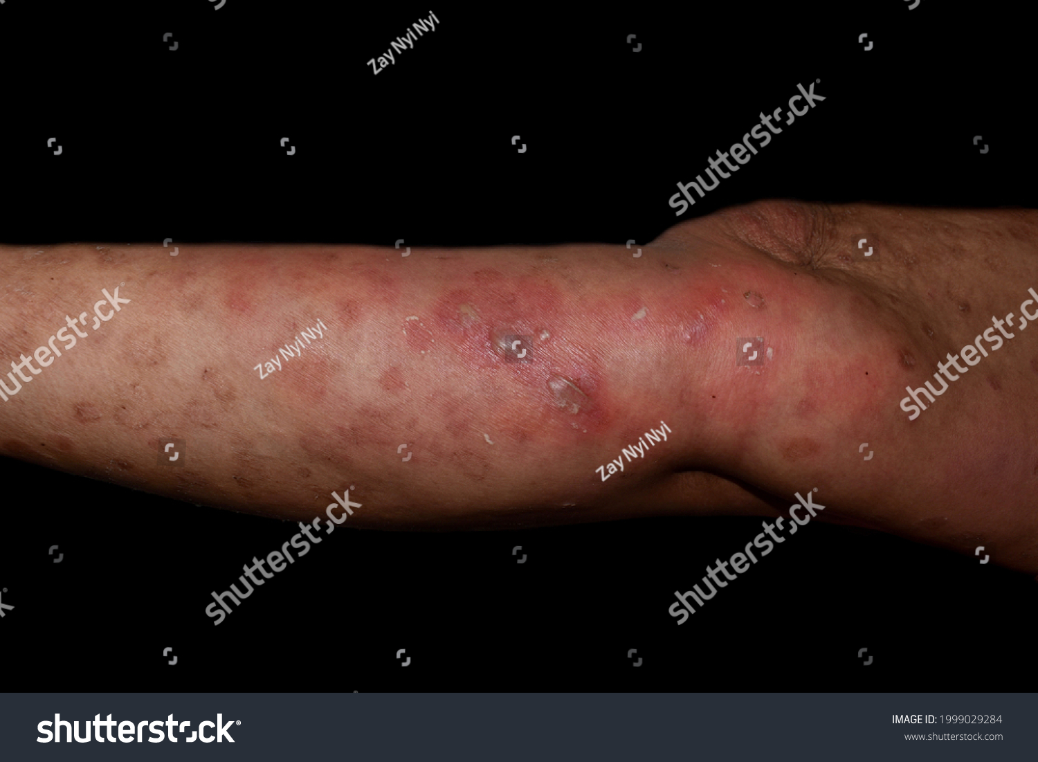 staphylococcal-streptococcal-skin-infection-bullous-impetigo-stock