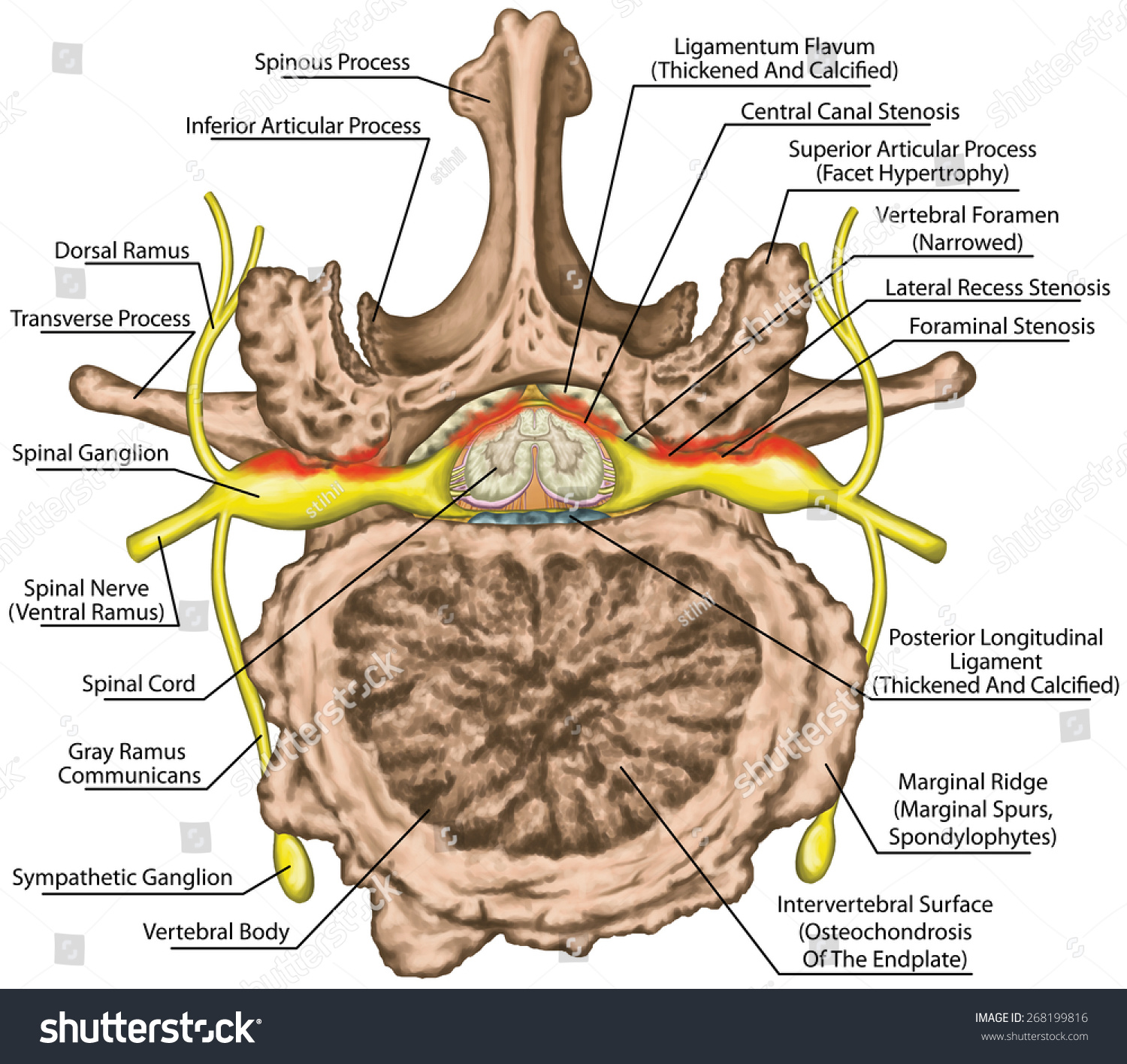 Stenosis, Central Lateral Stenosis, Nervous System, Spinal Cord, Lumbar ...