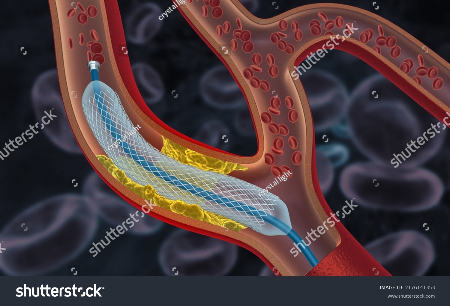 Stent Catheter Implantation Into Blood Vessel Stock Illustration ...