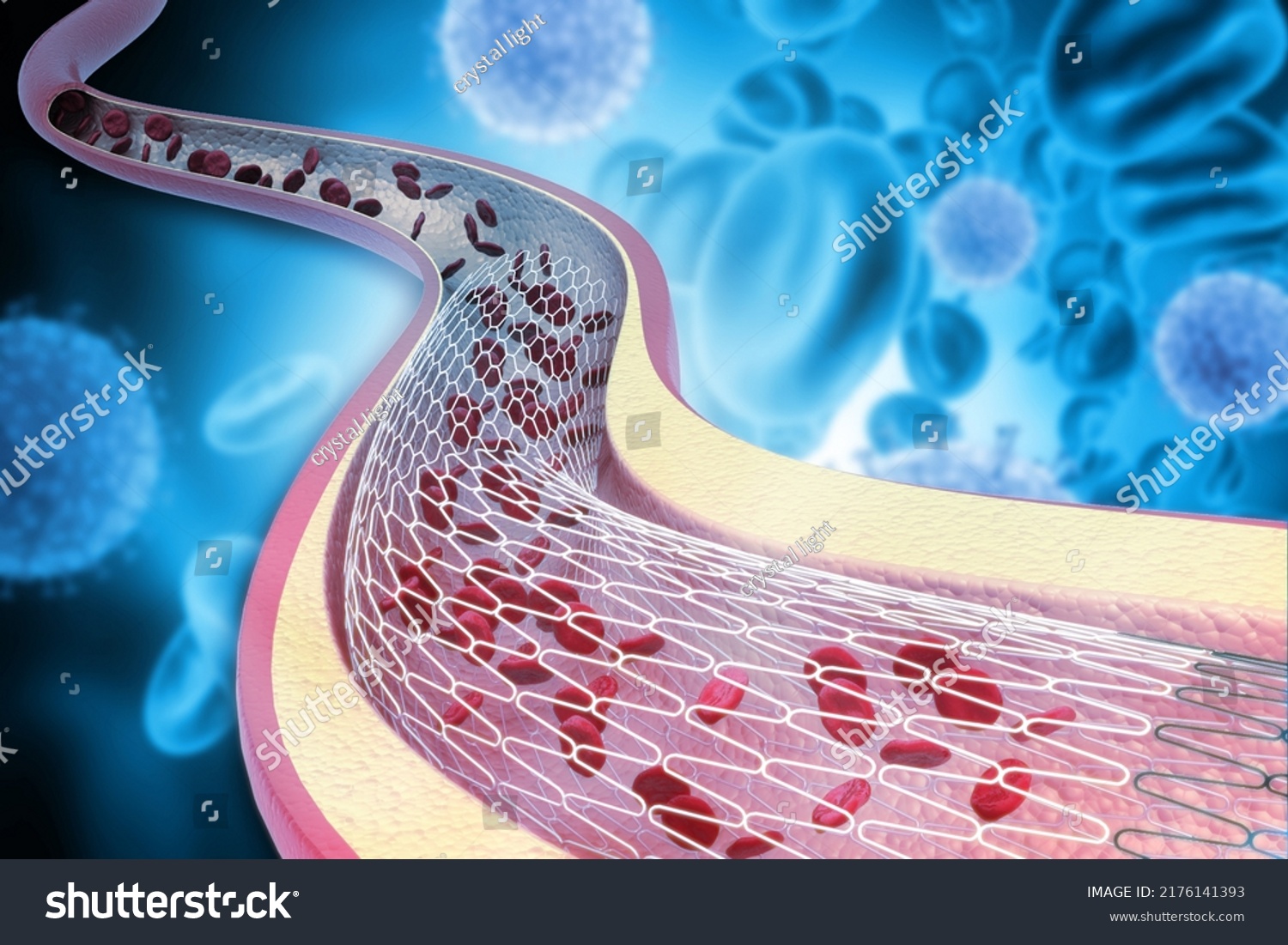 Stent Catheter Implantation Into Blood Vessels Stock Illustration(04)