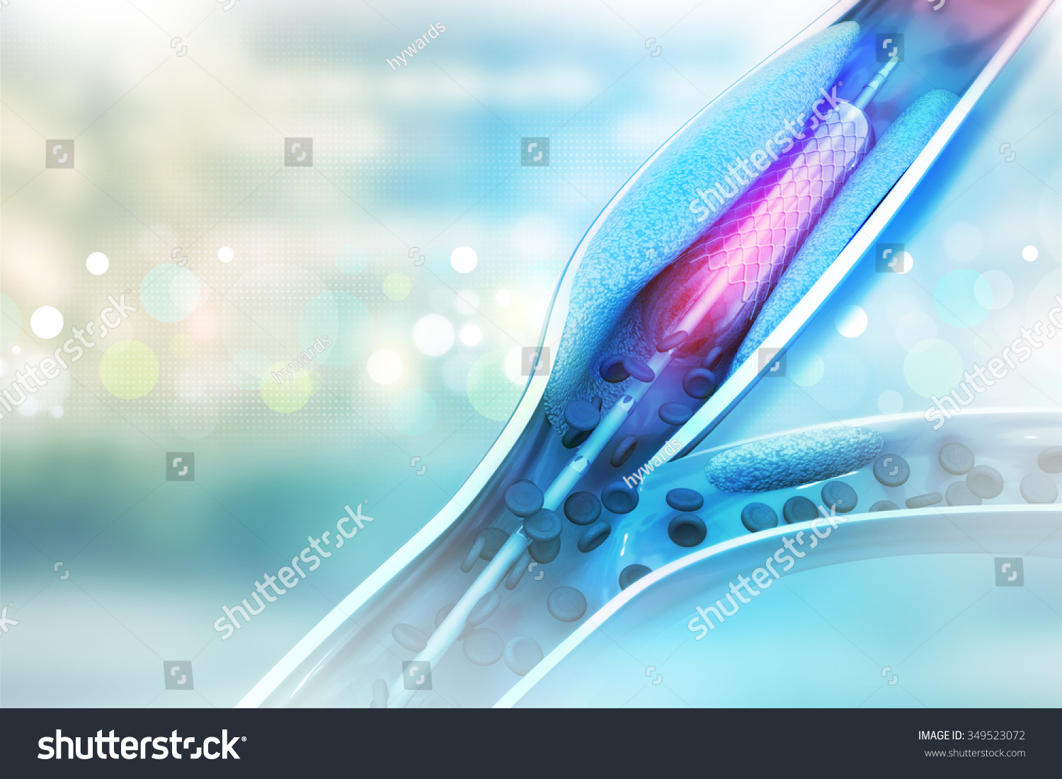 Stent Angioplasty Procedure Placing Balloon Stock Illustration 349523072