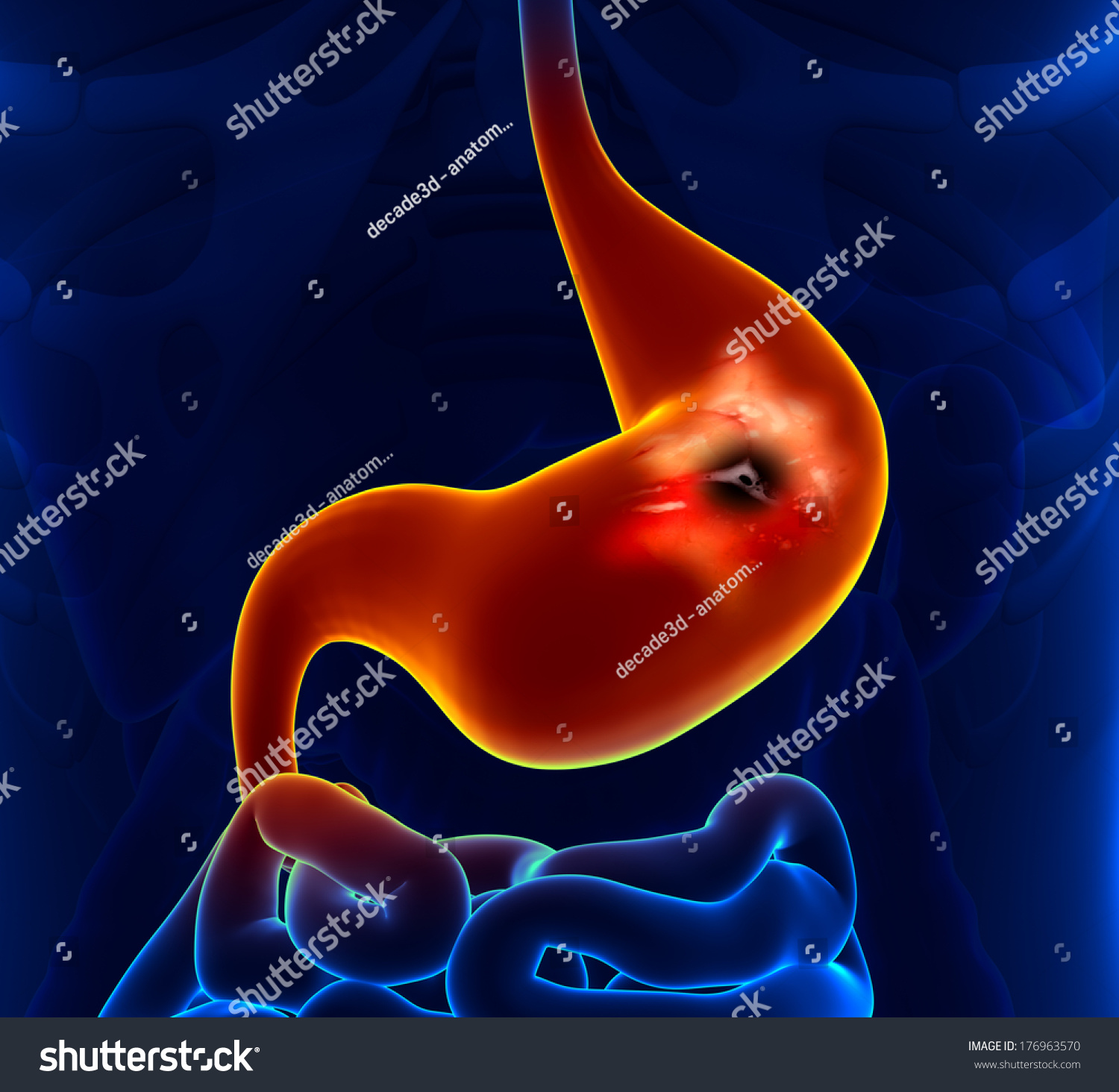 Stomach Cancer Stock Illustration 176963570 | Shutterstock