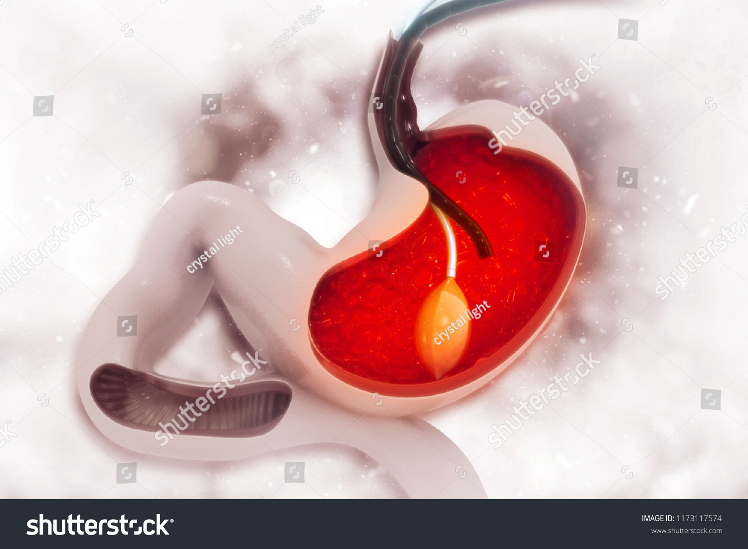 stomach-endoscopy-gastric-ballon-inside-stomach-stock-illustration