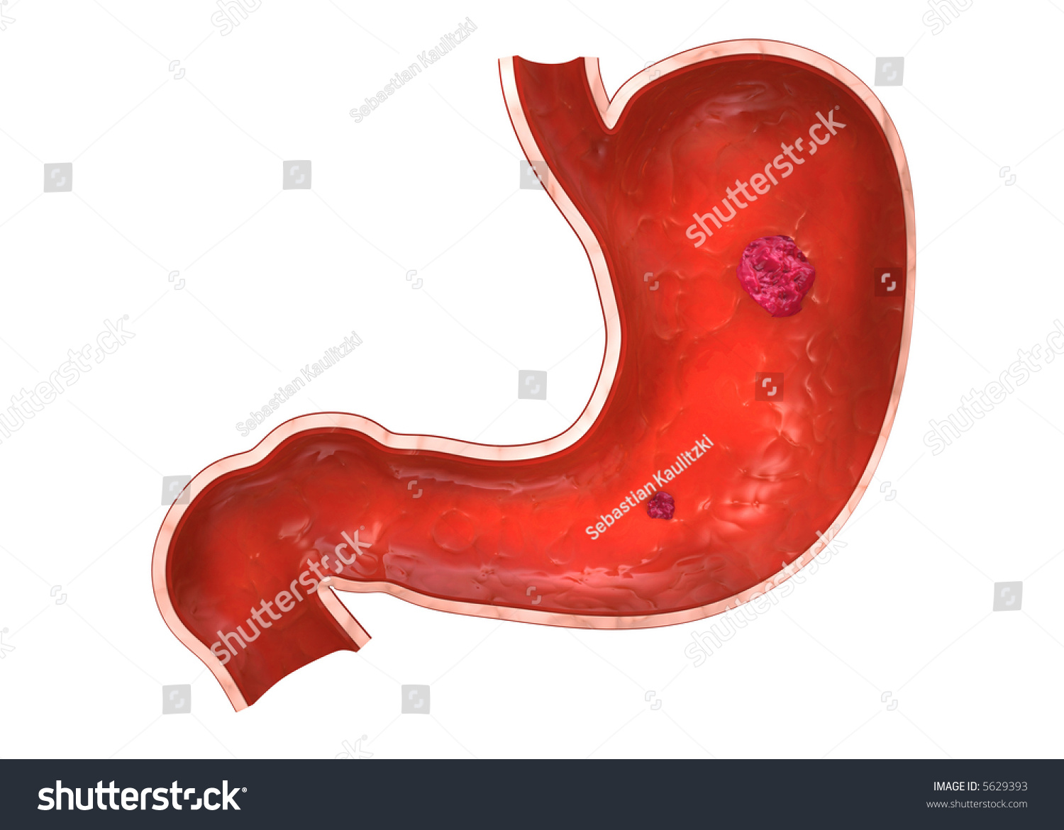 Stomach Ulcer/Tumor Stock Photo 5629393 : Shutterstock