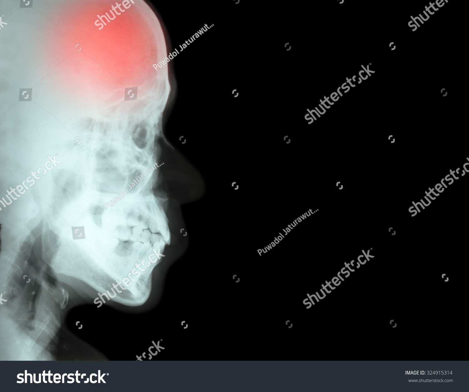 Stroke Cerebrovascular Accident Film Xray Skull Stock Photo 324915314