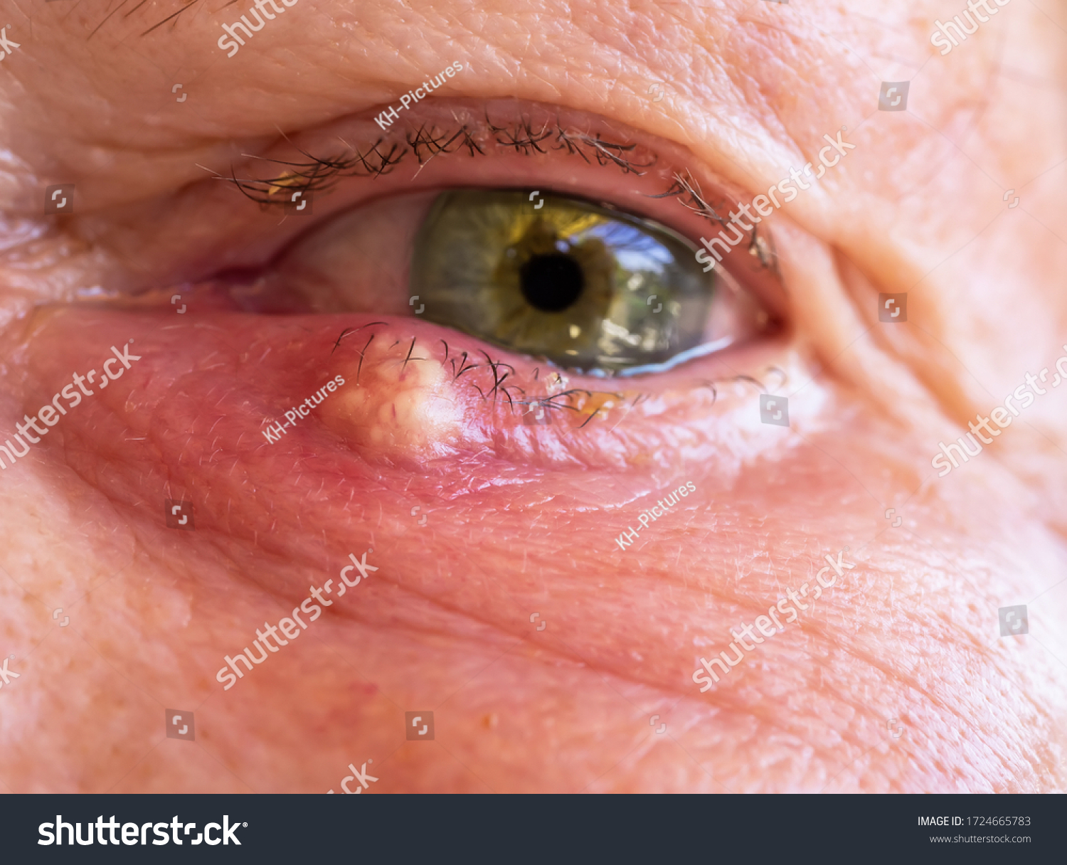 Stye Hordeolum Blepharitis Right Lower Eyelid Stock Photo 1724665783