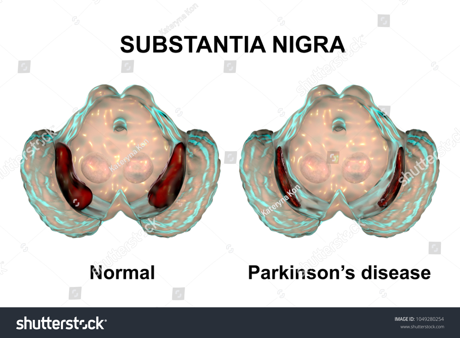 Substantia Nigra Norm Parkinsons Disease 3d Stock Illustration